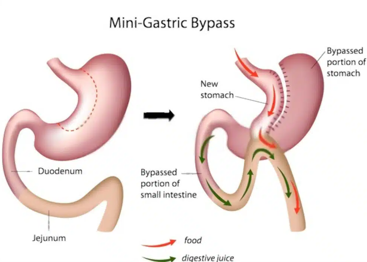 Mini Gastric Bypass 