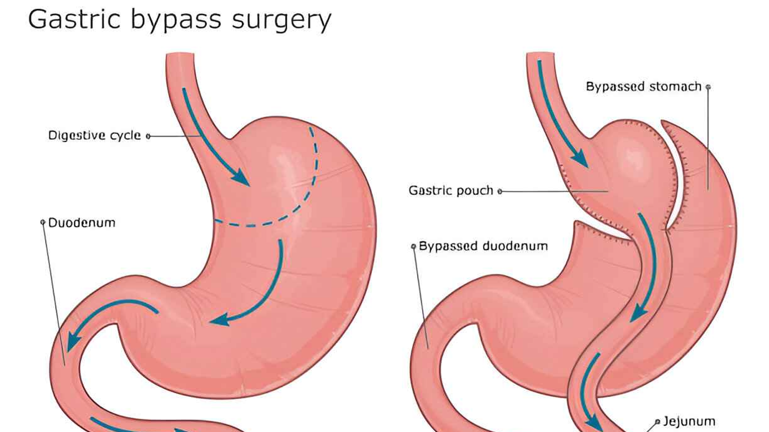 Gastric Bypass Abu Dhabi